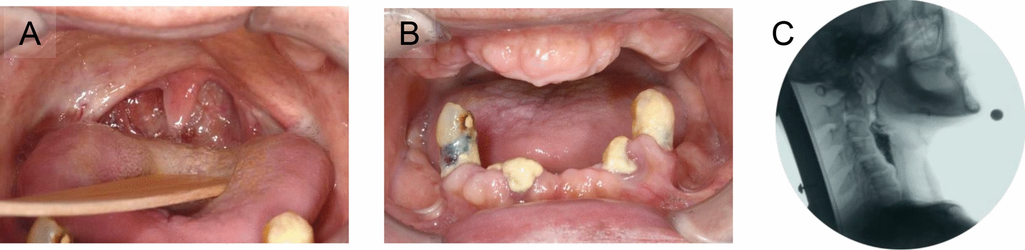 A Case of Dysphagia Rehabilitation in a Patient in the Chronic Stage of Lateral Medullary Syndrome
