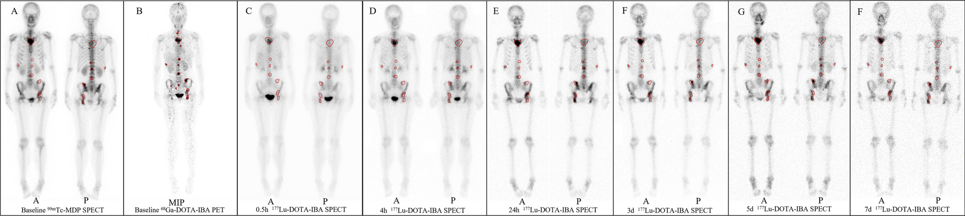 Biodistribution and dosimetry of 177Lu-DOTA-IBA for therapy of bone metastases