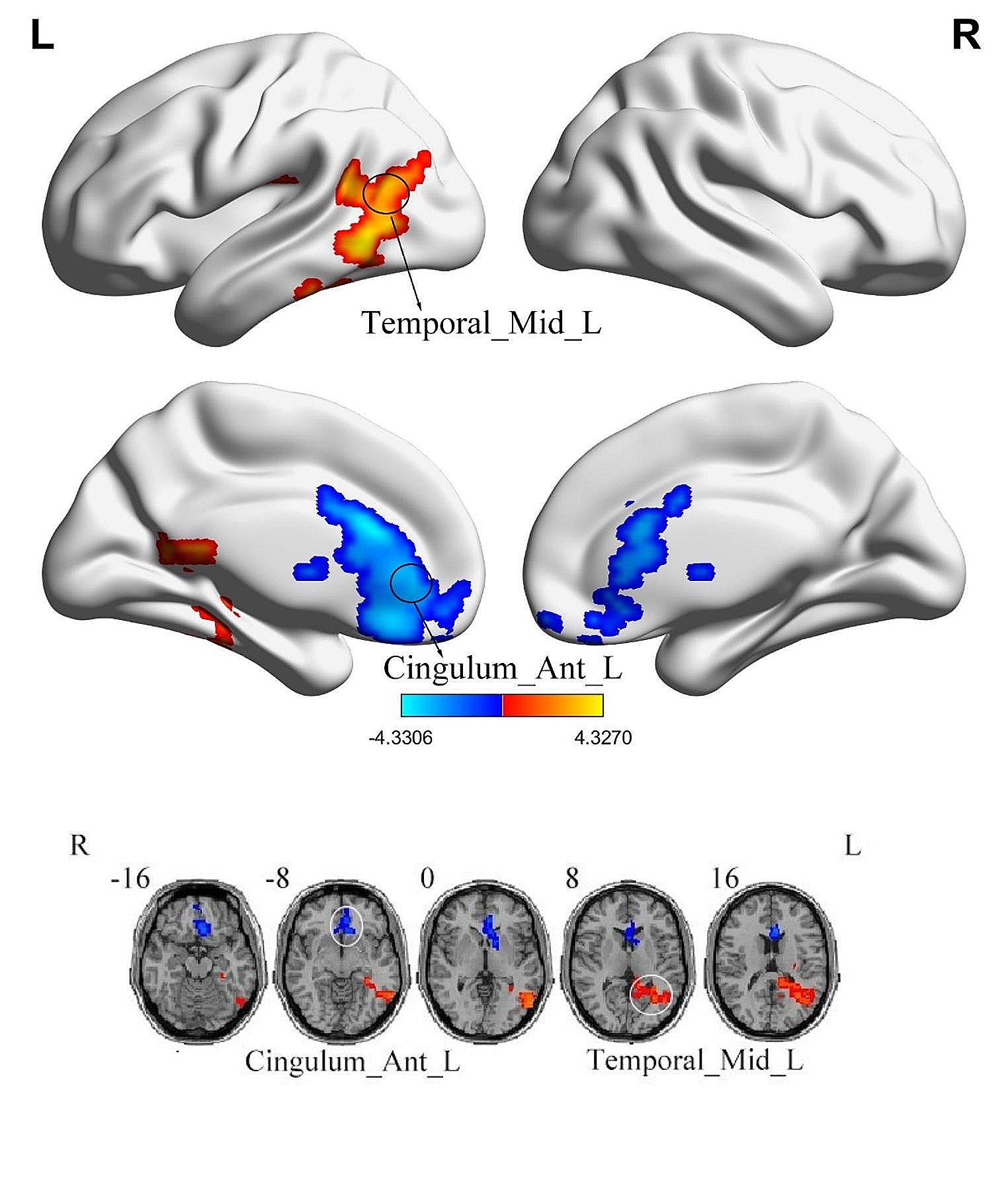 Alterations in degree centrality and functional connectivity in tension-type headache: a resting-state fMRI study