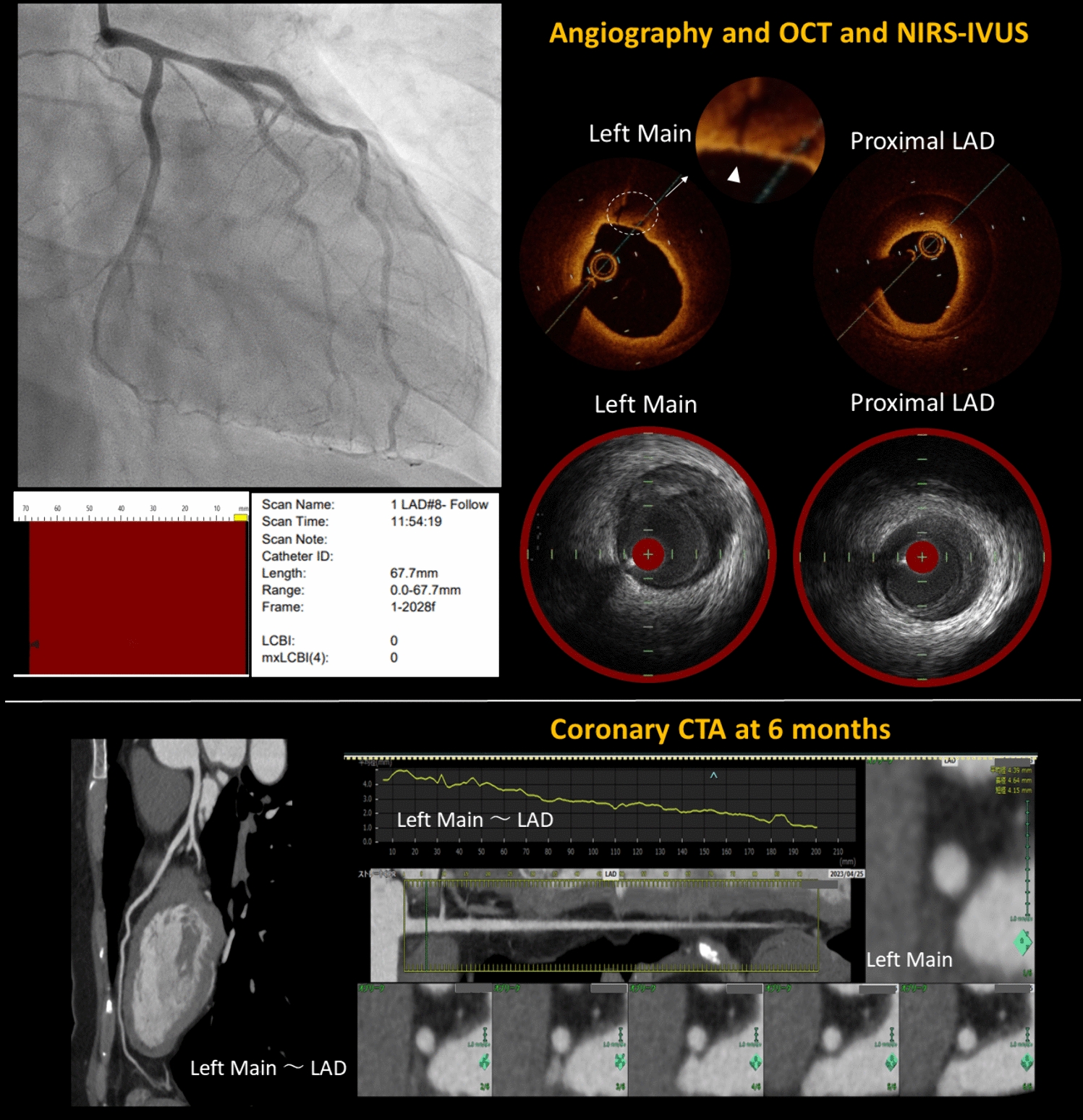Resolution of spontaneous coronary artery dissection involving the left main coronary artery
