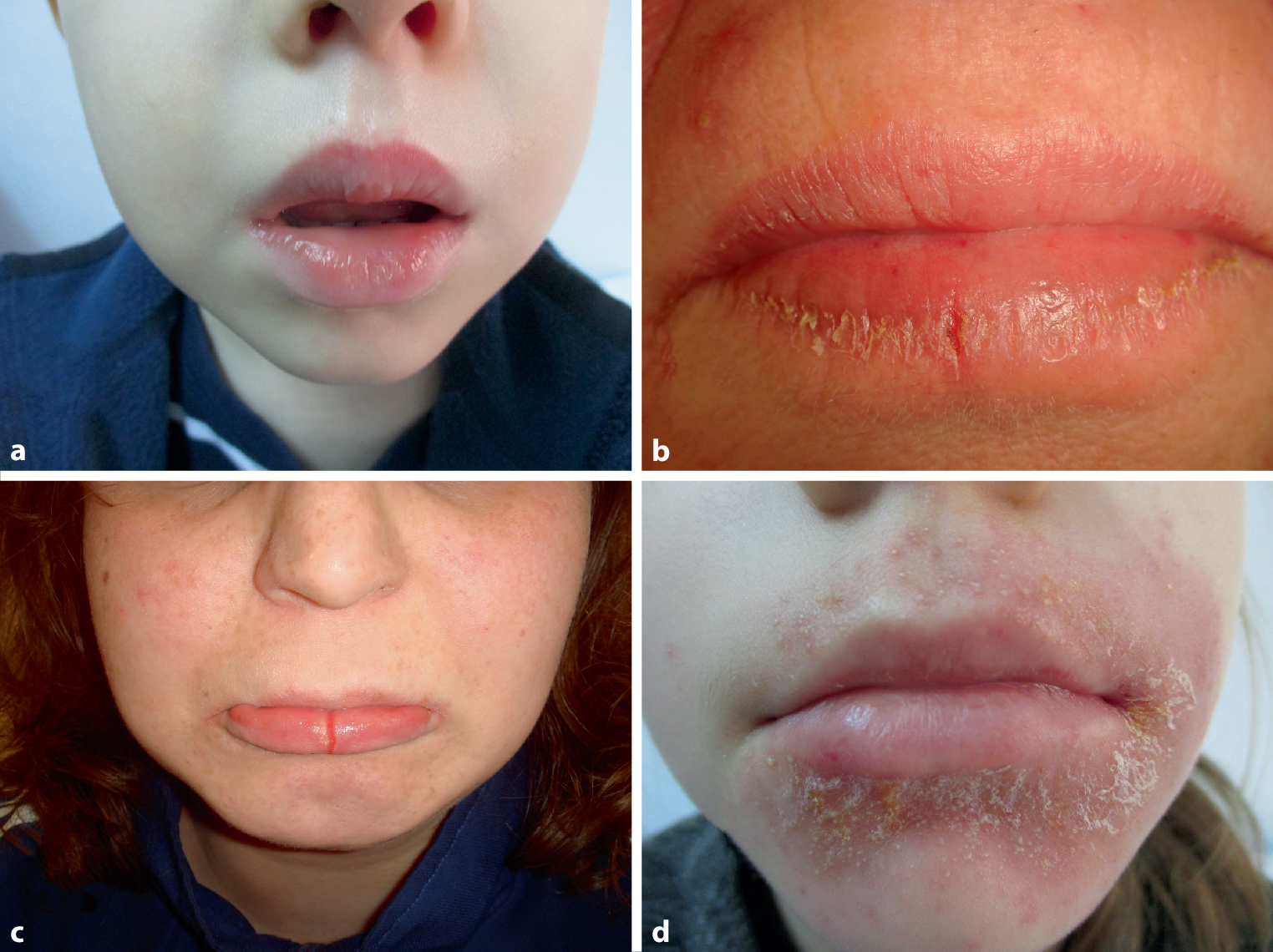 Angular cheilitis—an oral disease with many facets