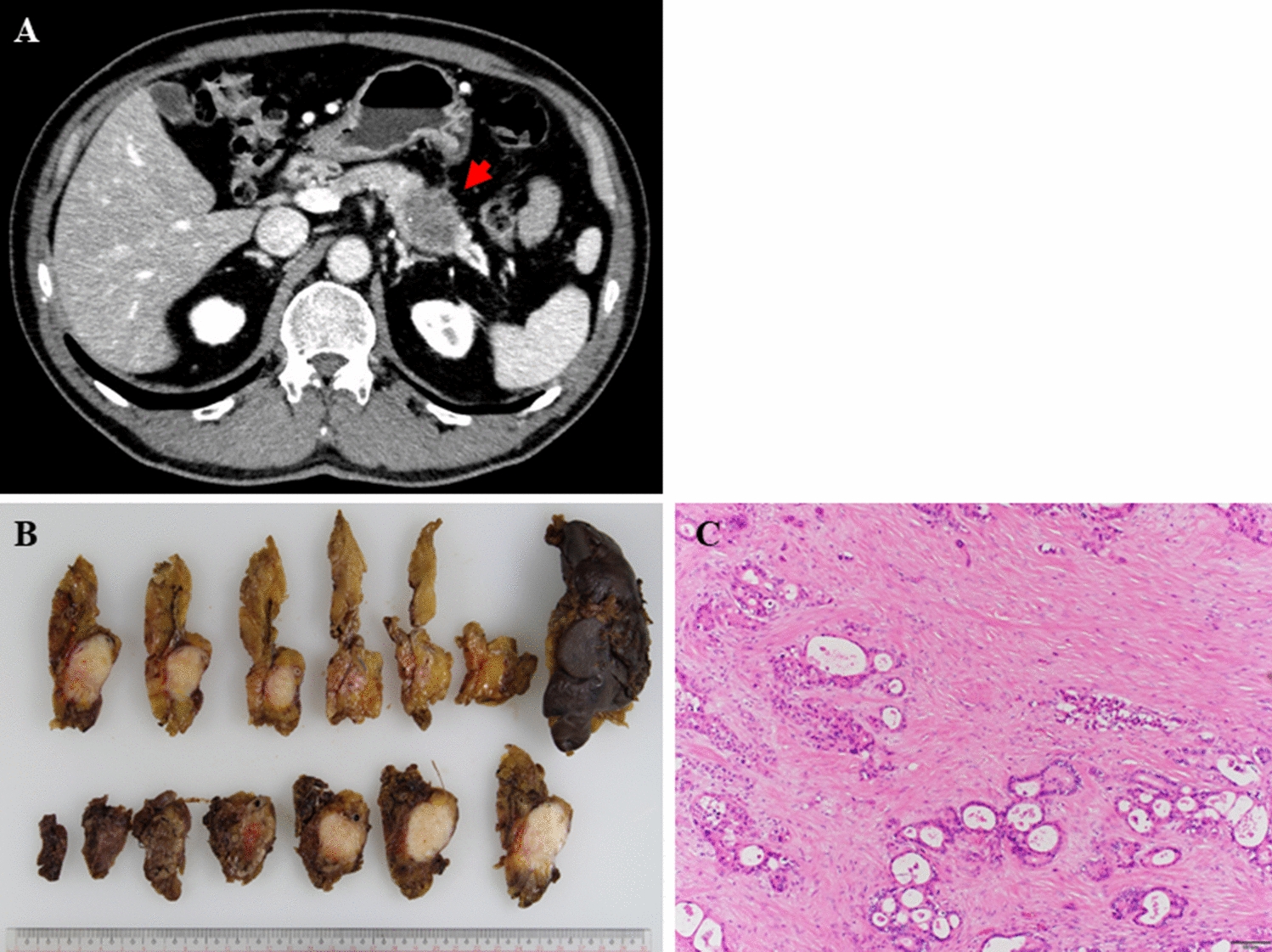 A case of metachronous oligo-hepatic and peritoneal metastases of pancreatic cancer with a favorable outcome after conversion surgery combined with perioperative sequential chemotherapy