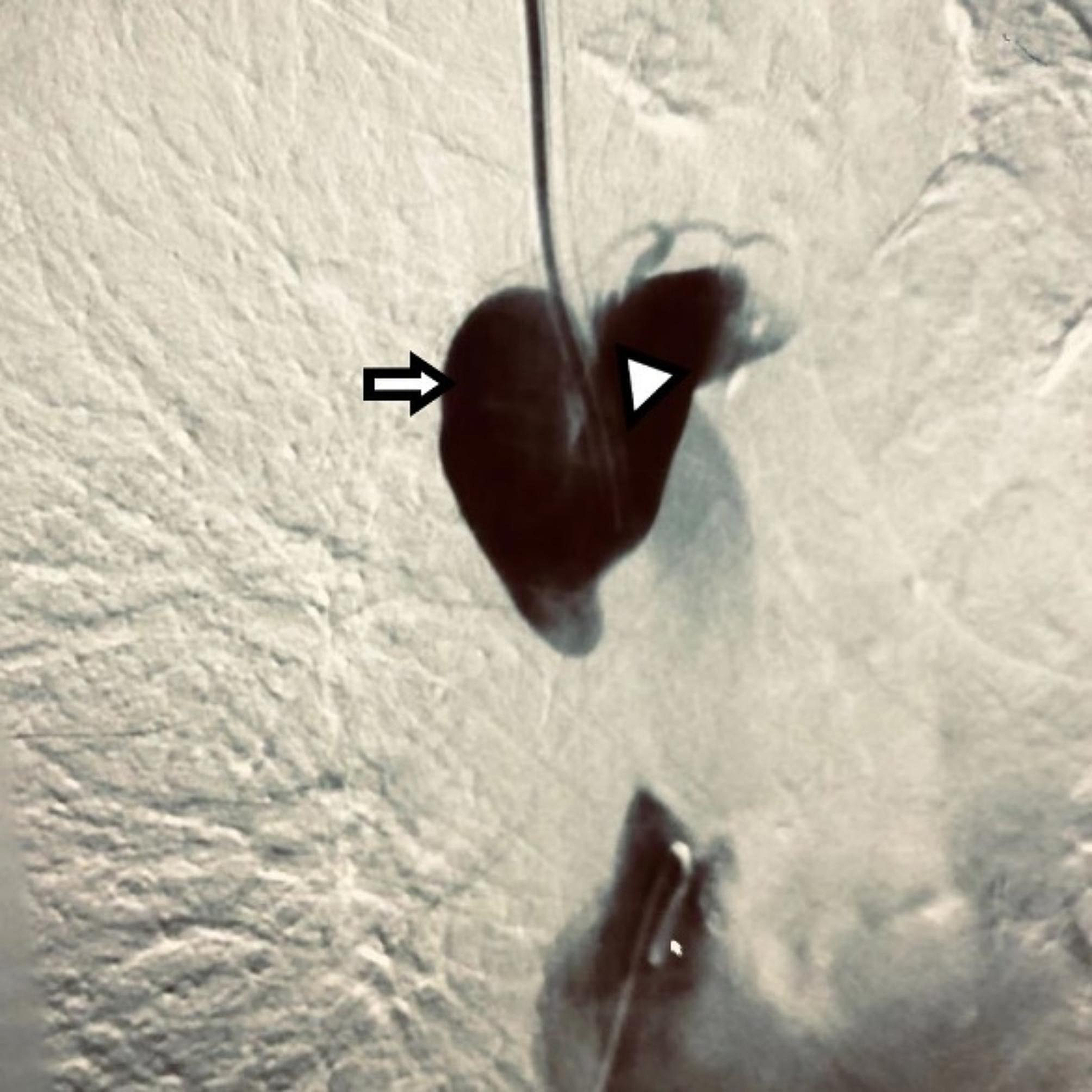 Hemorrhagic pericardial tamponade in a hemodialysis patient with catheter-related superior vena cava syndrome: a case report