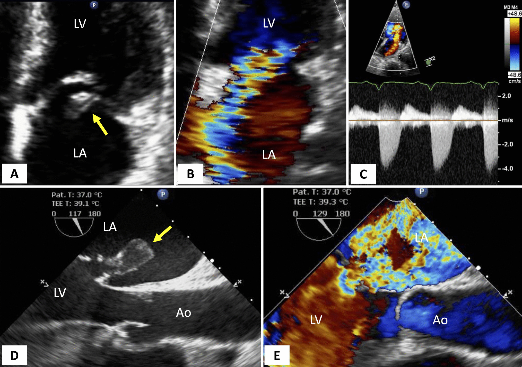 Echocardiography in the Recognition and Management of Mechanical Complications of Acute Myocardial Infarction