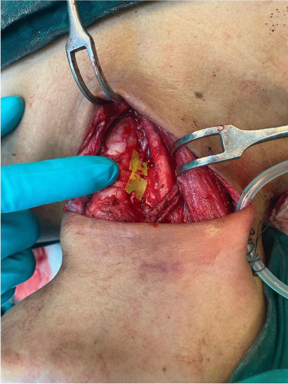 Long-Term Outcomes of Recurrent Laryngeal Nerve Repair/Reconstruction in Oncological Settings