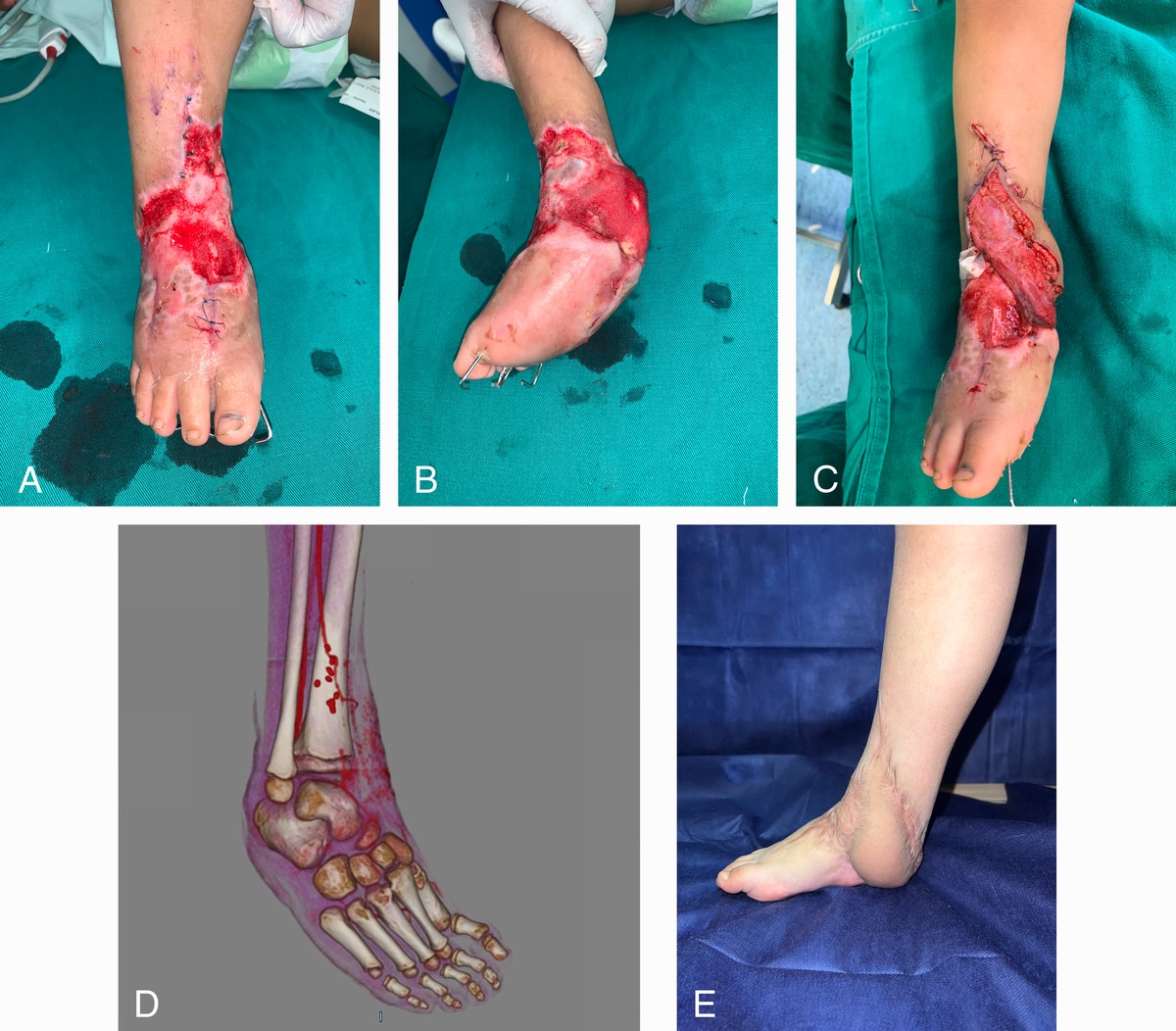 Quality of Life After Lower Leg Reconstruction With the Latissimus Dorsi Free Flap in Pediatric Patients