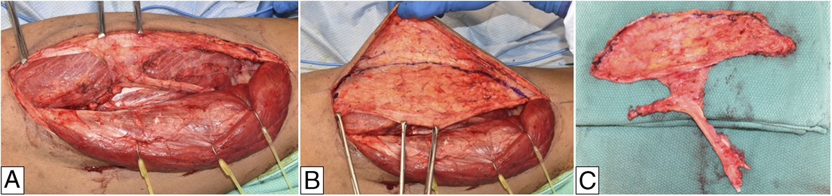 The Role of the Fascia-Only Anterolateral Thigh Flap in Extremity Reconstruction: The Fascia-Only Anterolateral Thigh Flap