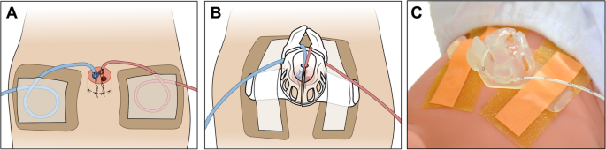 Reducing umbilical catheter migration rates by using a novel securement device