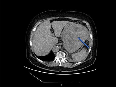 Case report: A case of high grade serous carcinoma of peritoneal origin