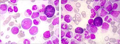 A case report of atypical chronic myeloid leukemia with complete hematological and major molecular response to Venetoclax/Azacitidine treatment
