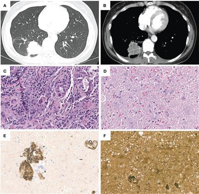 Case report: Molecular profiling facilitates the diagnosis of a challenging case of lung cancer with choriocarcinoma features