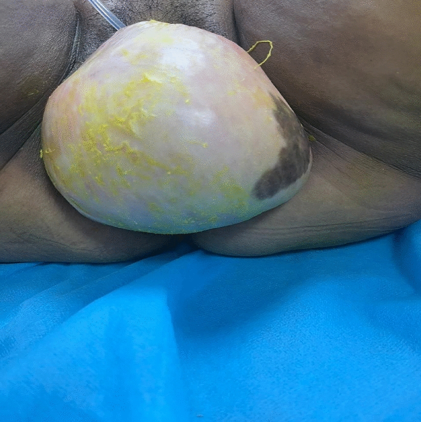 Symptomatic Vaginal Masses Mimicking Prolapse: Varied Clinical Course, Diagnosis and Their Management