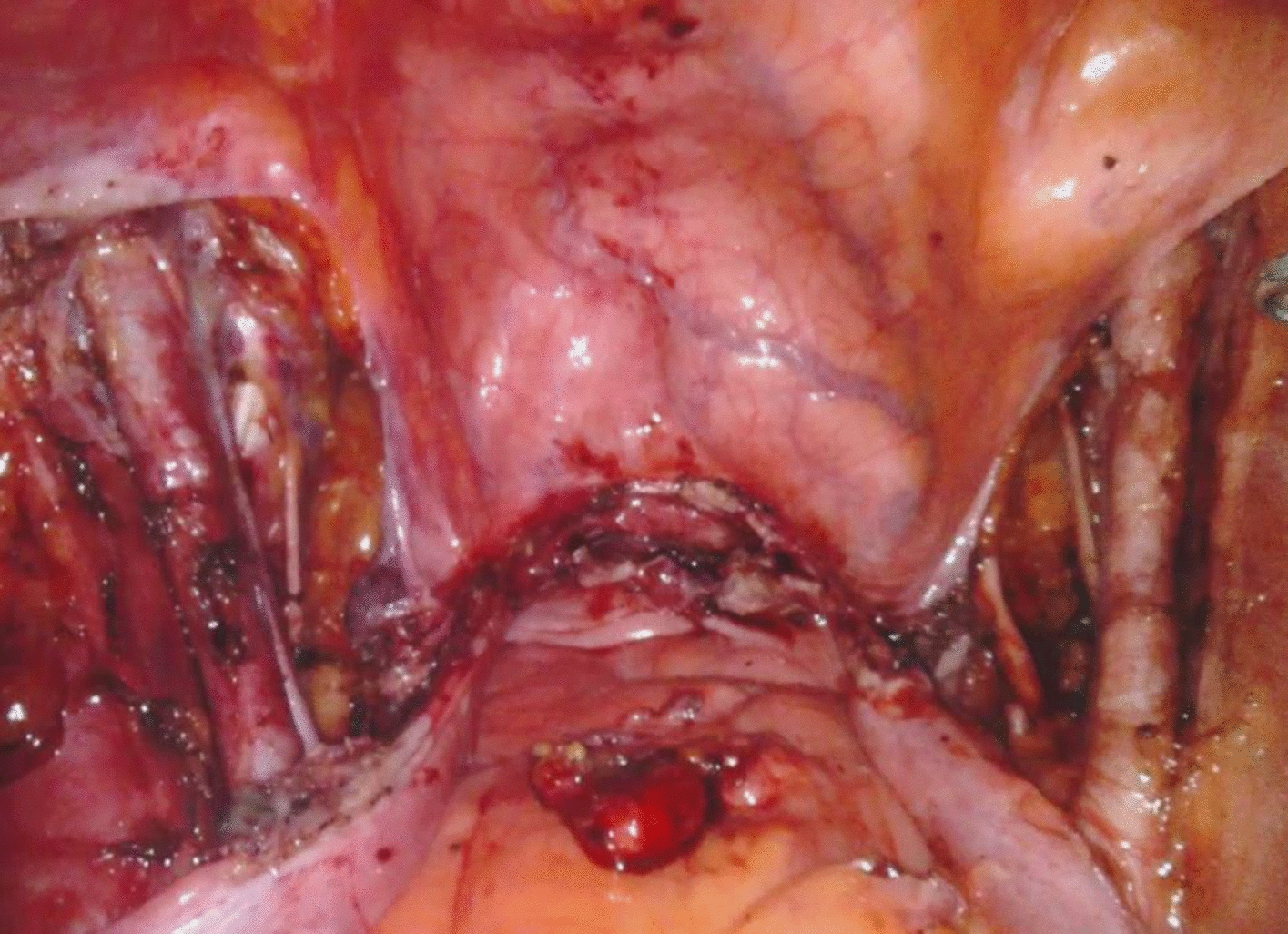 Lymphedema in Patients Undergoing Surgery for Endometrial Cancer: A Comparative Study of Sentinel Node Biopsy Versus Complete Pelvic Node Dissection