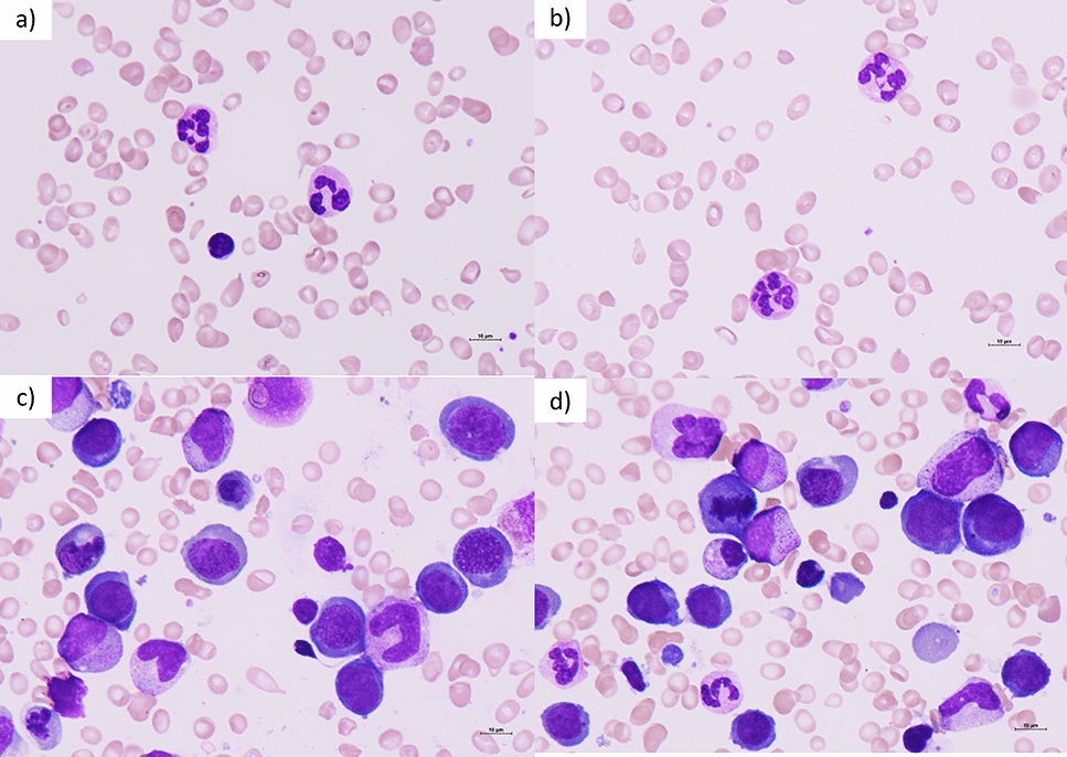 Vitamin B12 deficiency-induced megaloblastic anemia in a pediatric patient with autism spectrum disorder with a chronically unbalanced diet