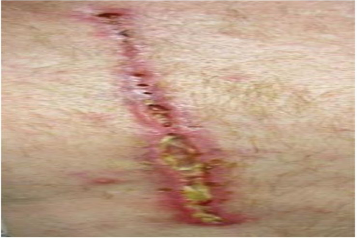 Patient With Sitosterolemia With Slow Healing Sternal Wound From Coronary Artery Bypass Surgery