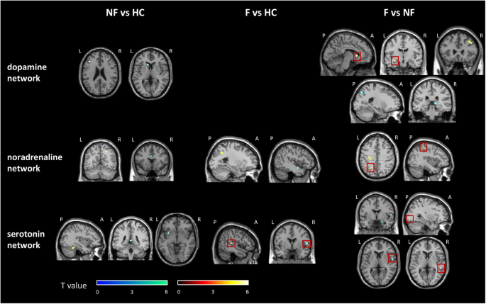 Resting state functional connectivity modifications in monoaminergic circuits underpin fatigue development in patients with multiple sclerosis