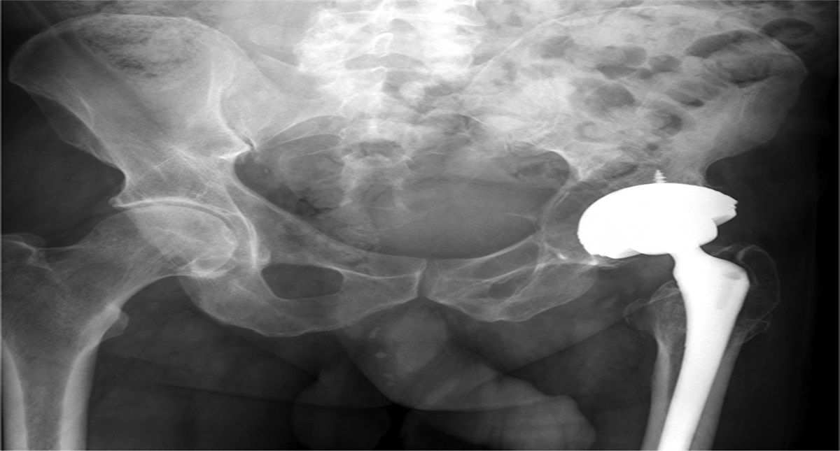 Pelvic Pseudotumor Associated With a Ceramic Bearing Total Hip