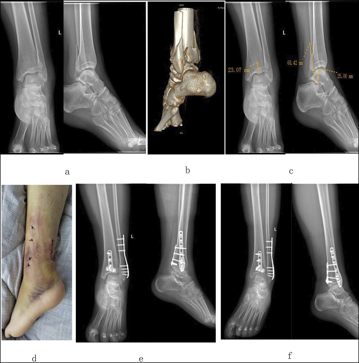 Limb Fractures Treated With the Novel Plate Osteosynthesis Application Technique: Second to Minimally Invasive Plates osteosynthesis
