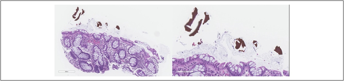 Sevelamer-Induced Gastrointestinal Disease in 12 Patients with End-Stage Renal Disease: A Case Series