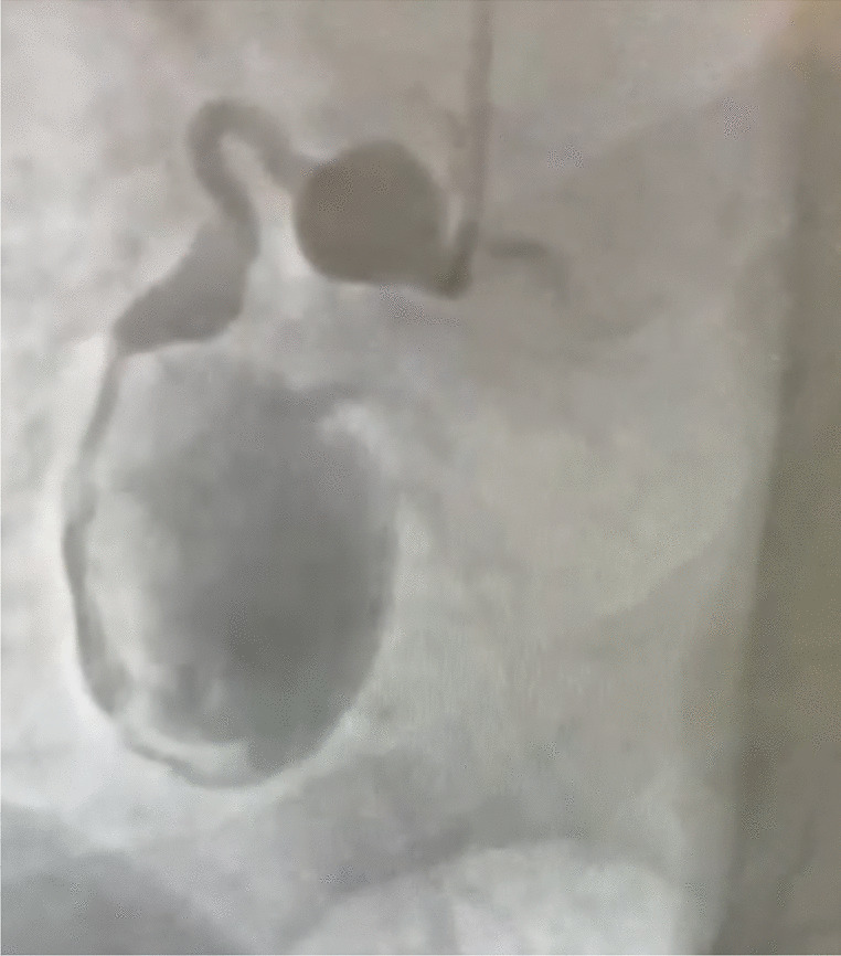 Giant coronary aneurysm and acute myocardial infarction: clinical case report and literature review