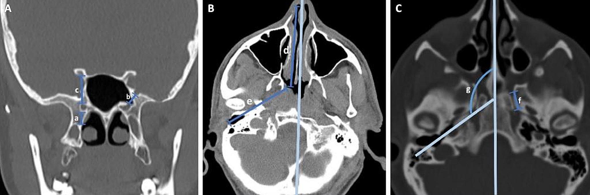 Endoscopic trans-eustachian tube approach: identifying the precise landmarks, a novel radiological and anatomical evaluation