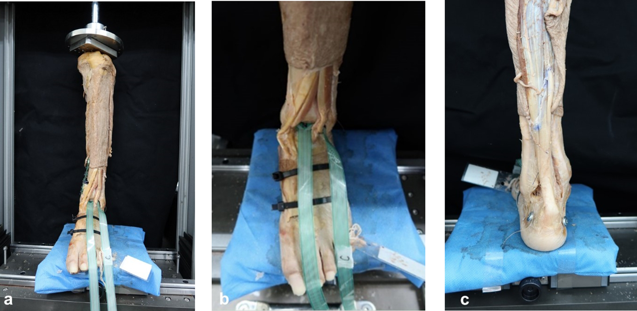 The effects of medial soft tissue release for varus deformity during medial open wedge supramalleolar osteotomy: a cadaveric study