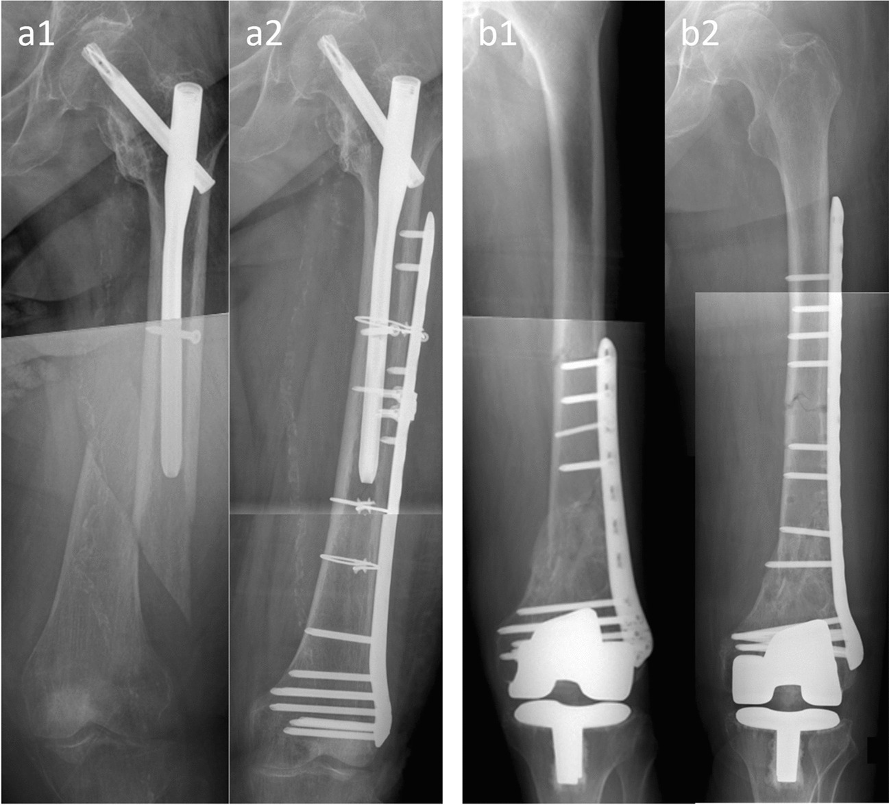 Therapy aspects of peri-implant femoral fractures—a retrospective analysis of 64 patients