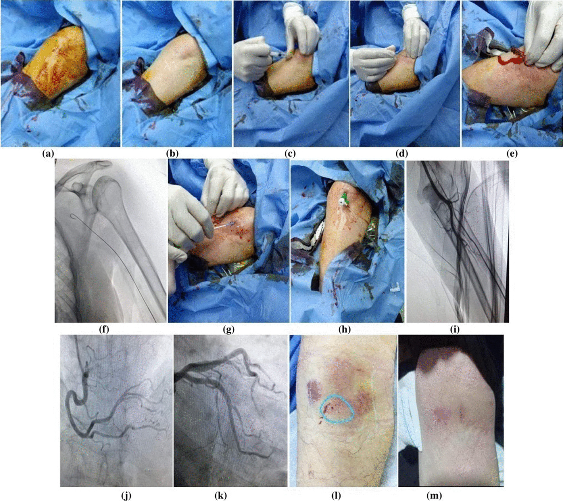 Safety and efficacy of brachial approach for coronary angiography and percutaneous coronary intervention