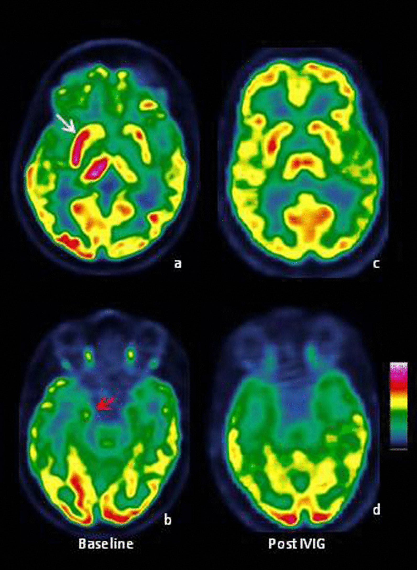 Anti-LGI1 autoimmune encephalitis: insights from three cases with serial PET imaging