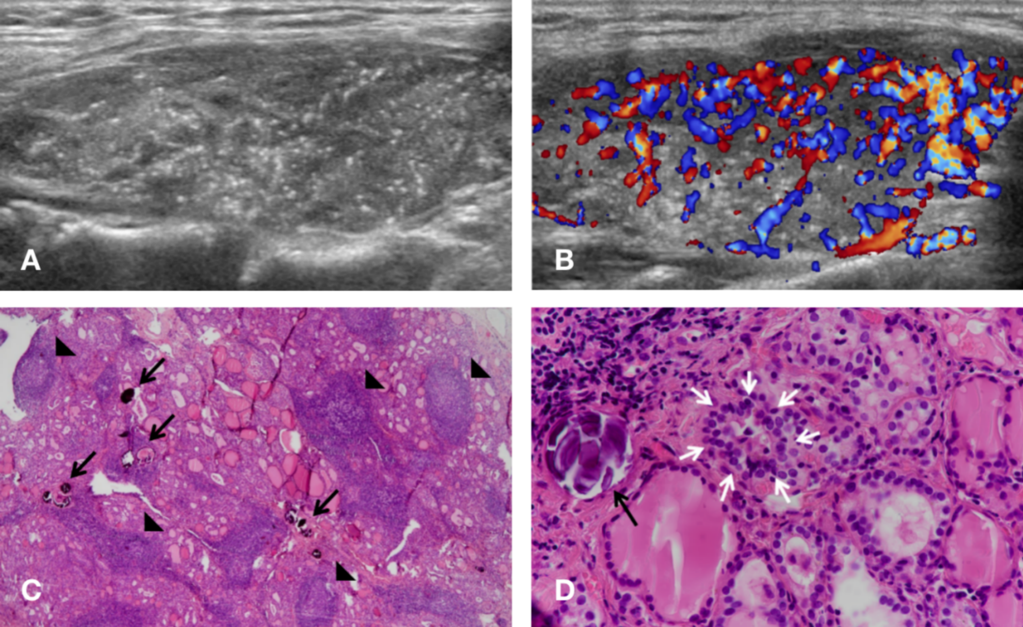 Sonographic characteristics of diffuse sclerosing variant of papillary thyroid carcinoma with histopathological correlation: a preliminary study