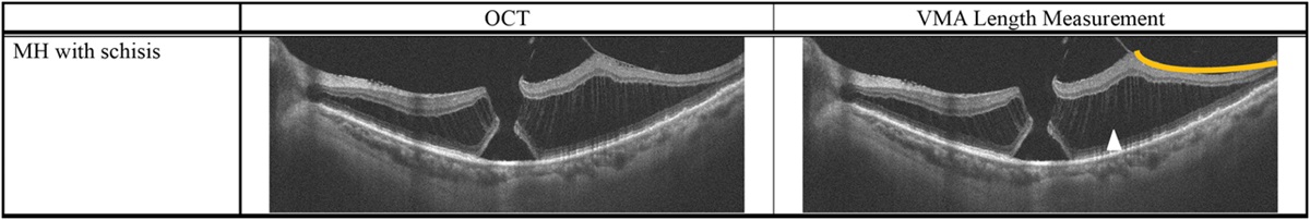 BROAD VITREOMACULAR ATTACHMENT-INDUCED MACULAR HOLE: Structural Changes and Surgical Outcome