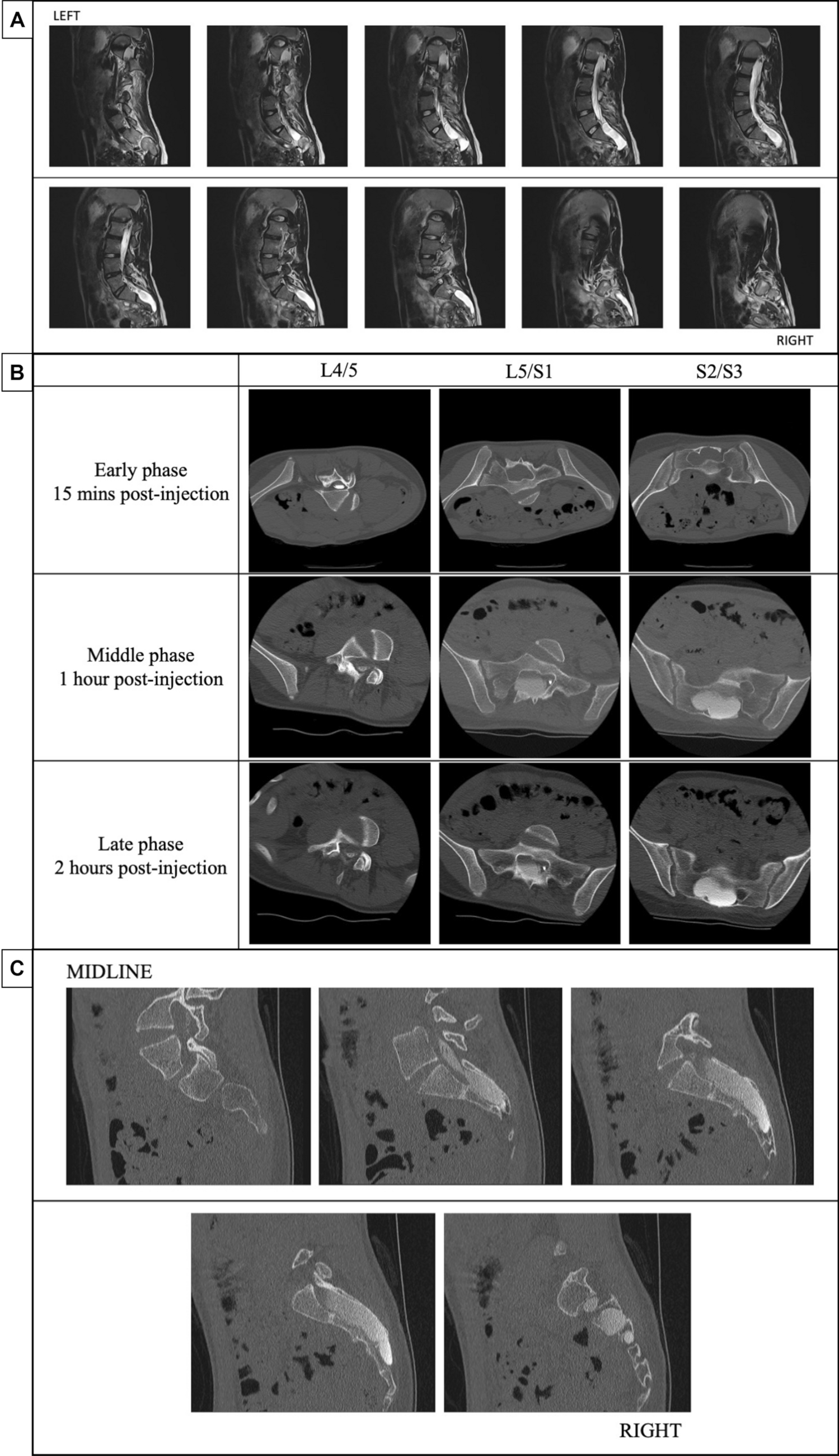 Large symptomatic sacral Tarlov cyst in a paediatric patient: case report and technical note on a new variation of surgical technique to overcome one-way check-valve mechanism