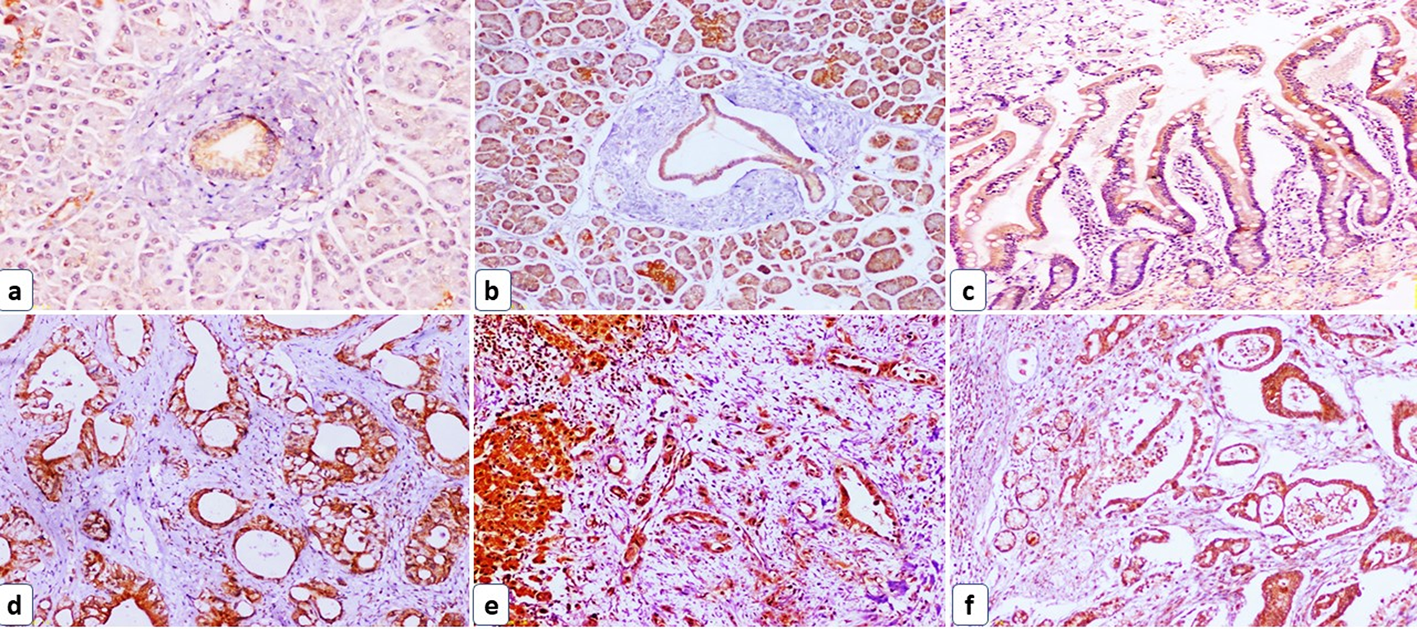 STIM1/SOX2 proteins are co-expressed in the tumor and microenvironmental stromal cells of pancreatic ductal adenocarcinoma and ampullary carcinoma