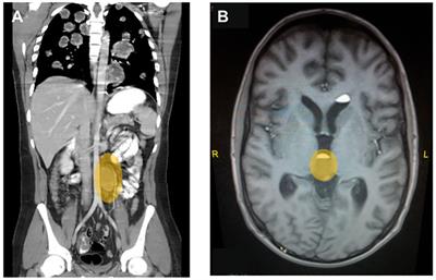 Hyperthyroidism in non-seminomatous testicular germ cell tumors: two case reports and literature review