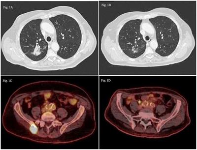 Outcomes of non-small cell lung cancer patients with non-V600E BRAF mutations: a series of case reports and literature review