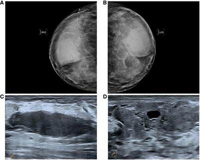 A case report and a literature review of double mammary pseudoangiomatous stromal hyperplasia associated with galactoma during pregnancy