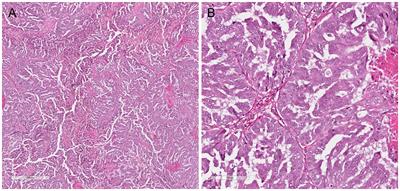 Case report: Response to everolimus in a patient with platinum resistant, high grade serous ovarian carcinoma with biallelic TSC2 inactivation