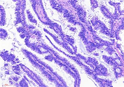 Invasive papillary carcinoma of the breast