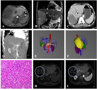 Resection of unresectable hepatocellular carcinoma after conversion therapy with apatinib and camrelizumab: a case report and literature review