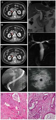 Case report: The diagnostic dilemma of indeterminate biliary strictures: report on two cases with a literature review