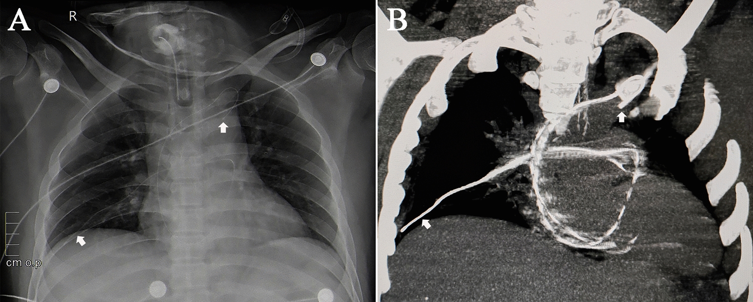 Peripherally inserted central catheter fracture and migration