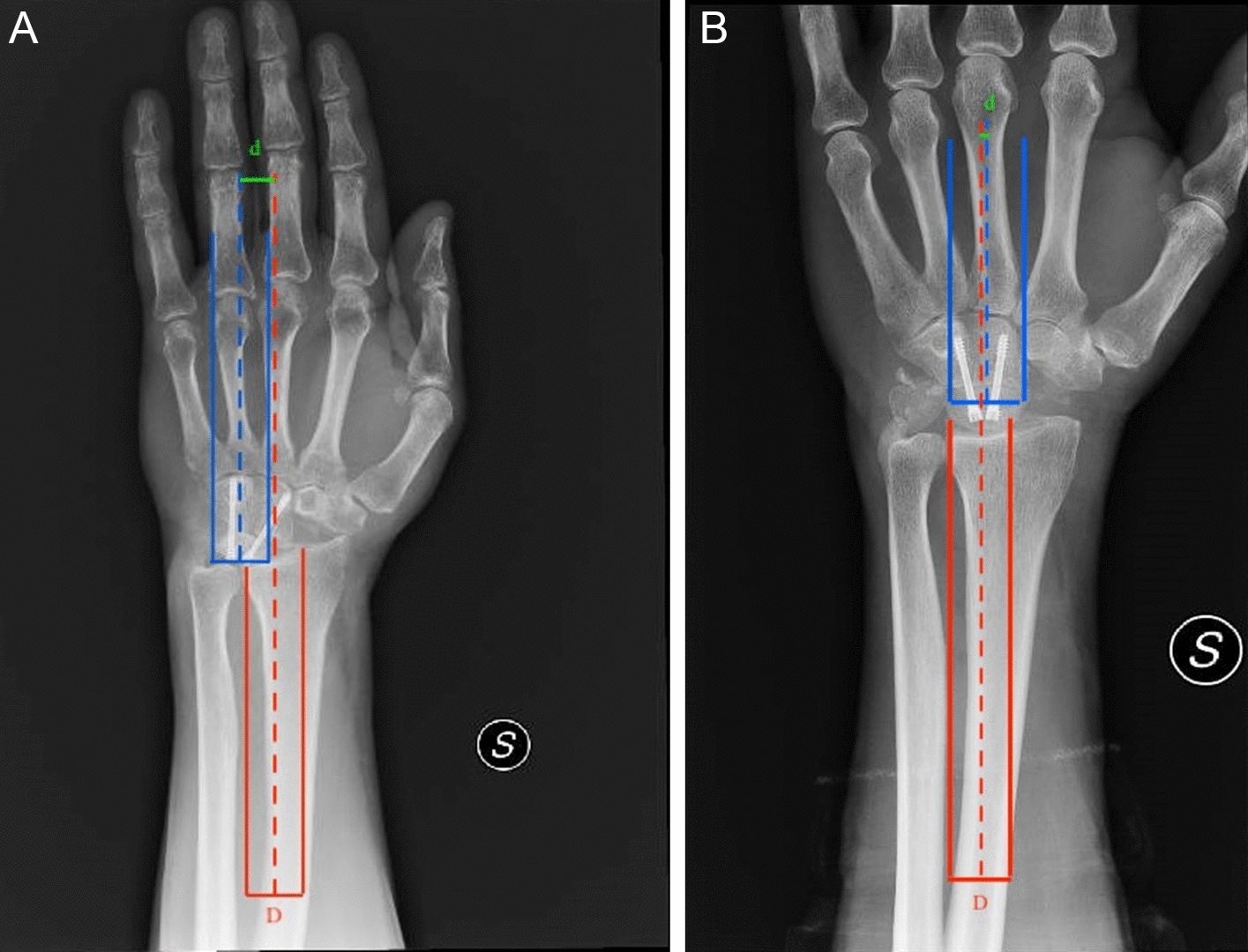 Lunate Shift Index (LSI): A New Parameter for the Evaluation of Residual Ulnar Side Wrist Pain in Patients with Wrist Osteoarthritis Undergoing Three-Corners Arthrodesis vs. Four-Corners Arthrodesis—A Retrospective Comparative Study with Minimum 2 Years of Follow-up