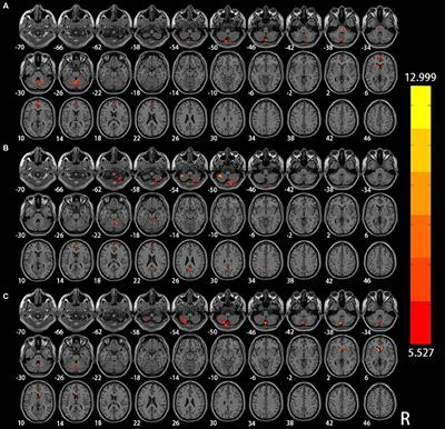 Frequency-dependent alterations in functional connectivity in patients with Alzheimer’s Disease spectrum disorders