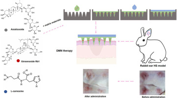Layered dissolving microneedle containing a three-drug combination on the treatment of hypertrophic scar