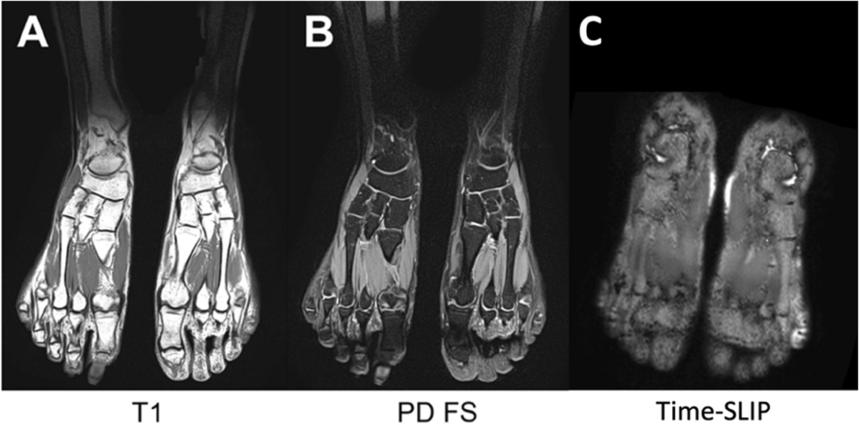 Non-contrast MRI of micro-vascularity of the feet and toes