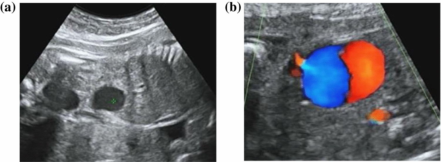 Spontaneous echo contrast and decreased umbilical vein blood flow may predict thrombus formation in fetal intra-abdominal umbilical vein varix