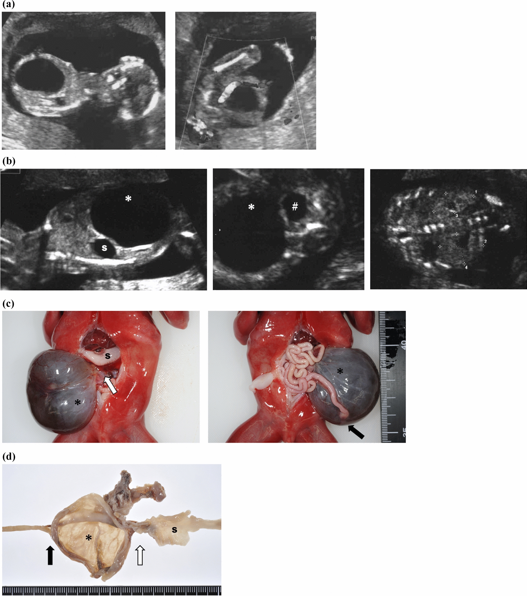 A case of fetal duodenal atresia suspected to be lower urinary tract obstruction