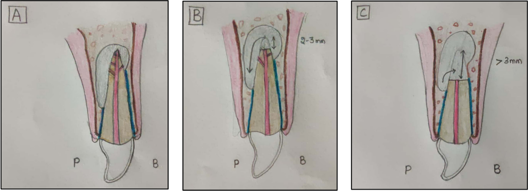 Root End Resection in Periapical Surgeries: A Contention of Opinion Between an Oral Surgeon and an Endodontist