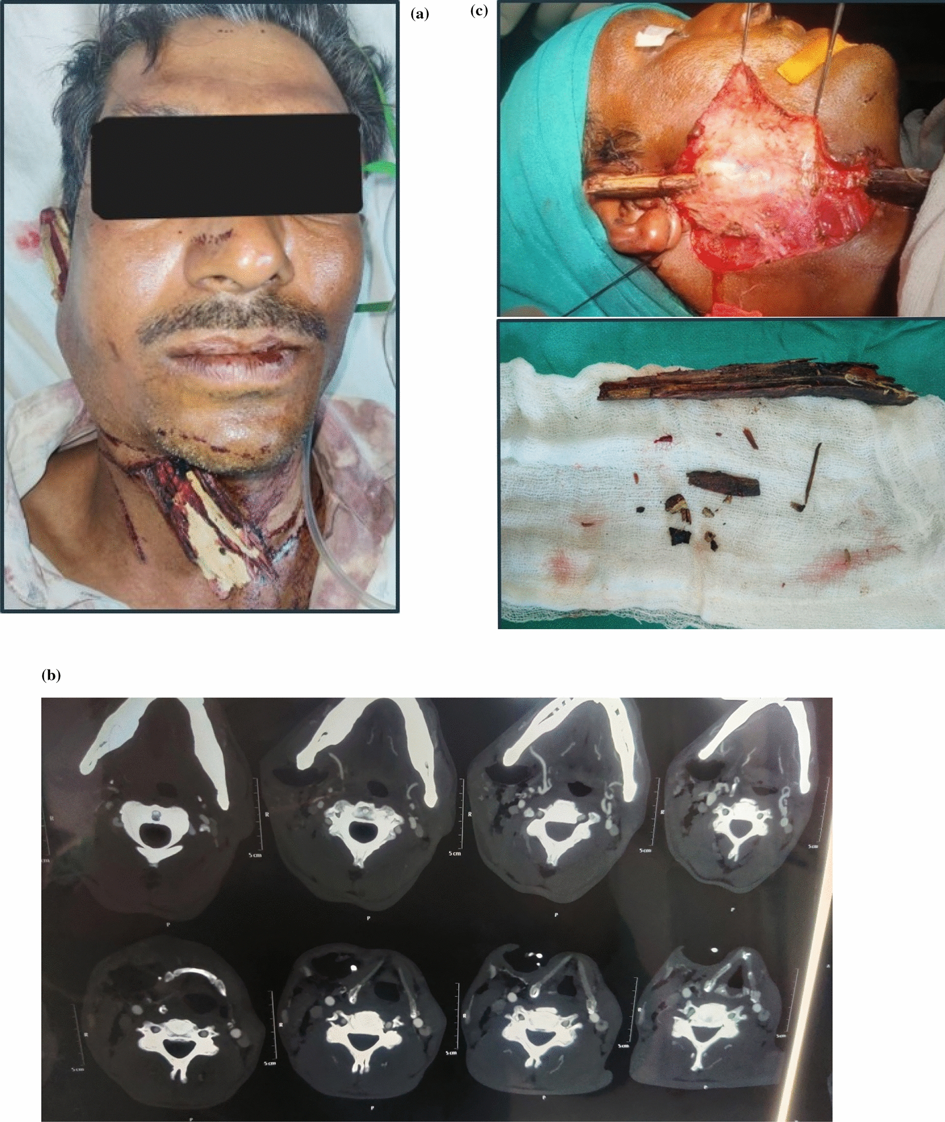 Complex-Type Foreign Body Penetrating Injuries of the Craniofacial Region and Surgical Management: A Report of Three Cases
