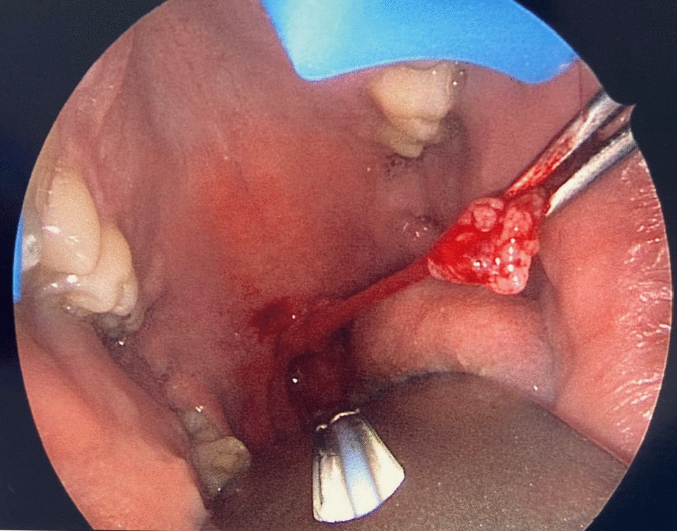 A Rare Case of an Elongated Uvula Causing Episodic Dysphagia and Coughing Fits
